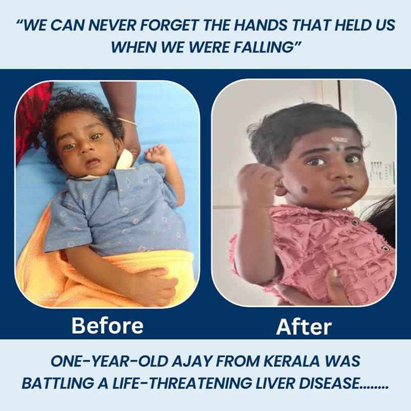 Ajay Krishna’s success story of liver transplant 